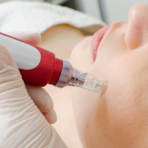 Dermapen com Dr. Pen - 11 de Fevereiro