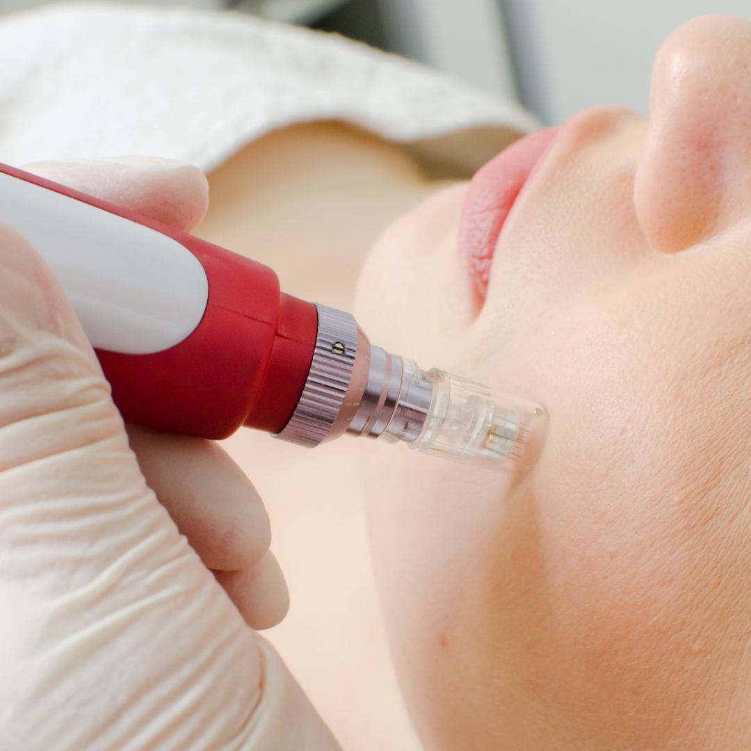 Dermapen com Dr. Pen - 11 de Fevereiro